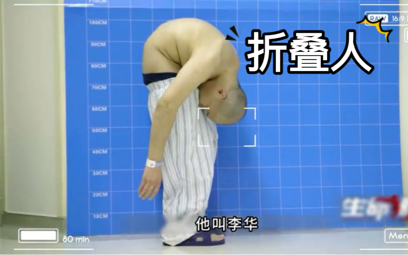 男子身体折叠接近180度,敲断骨头4次#折叠人