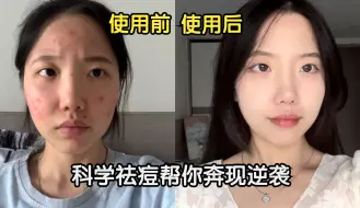 Télécharger la video: 【痘肌的春天】网恋时满脸痘痘黄脸婆，奔现时逆袭白嫩大学生！