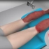 3D医学动画：烧伤皮肤移植植皮手术治疗