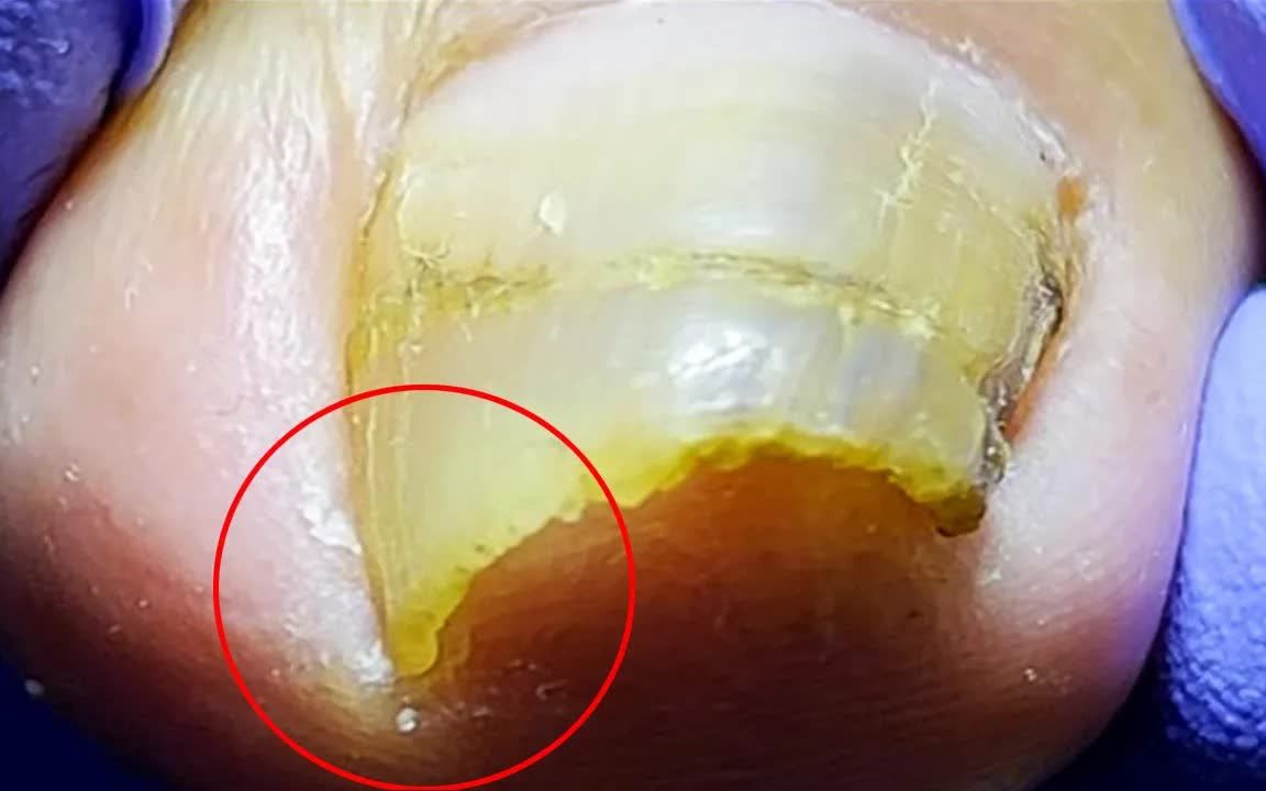 可以想象多肿痛,专业修脚,爽了【刘一刀修甲】