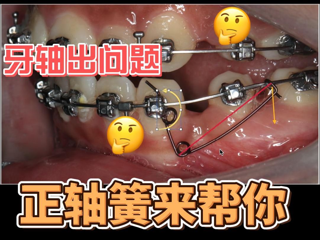 正畸双曲舌簧弯制图解图片