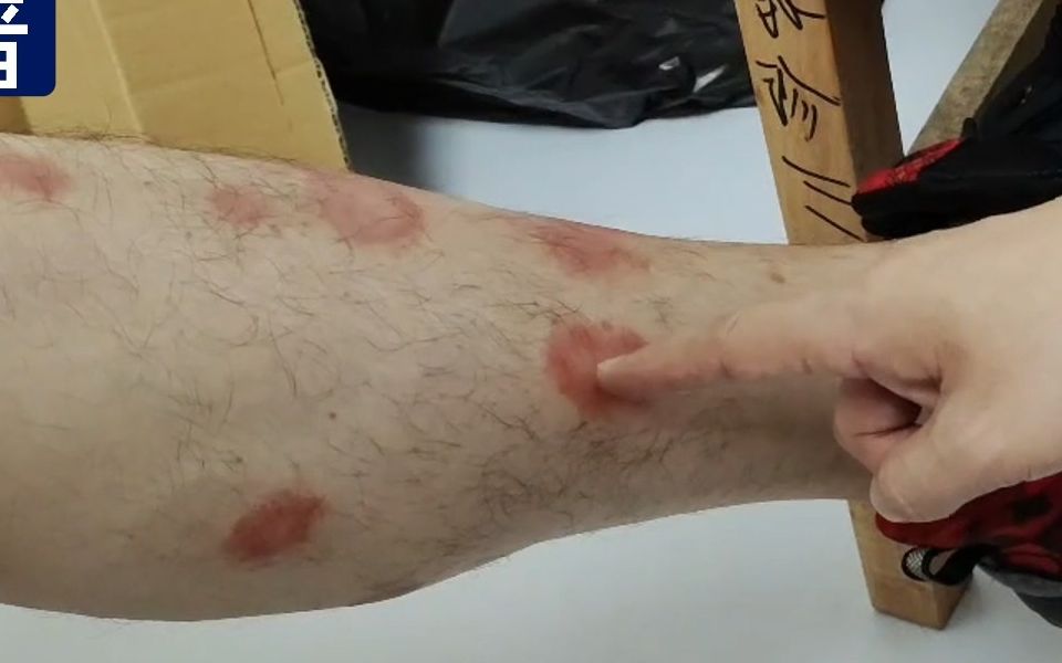 男子大腿全是红色牛皮癣,洗澡时发现皮肤会变白,欣喜不已!