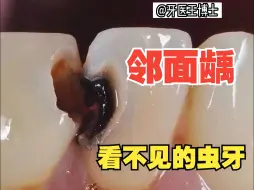 下载视频: 邻面龋修复过程：一个不易被发现的龋齿！