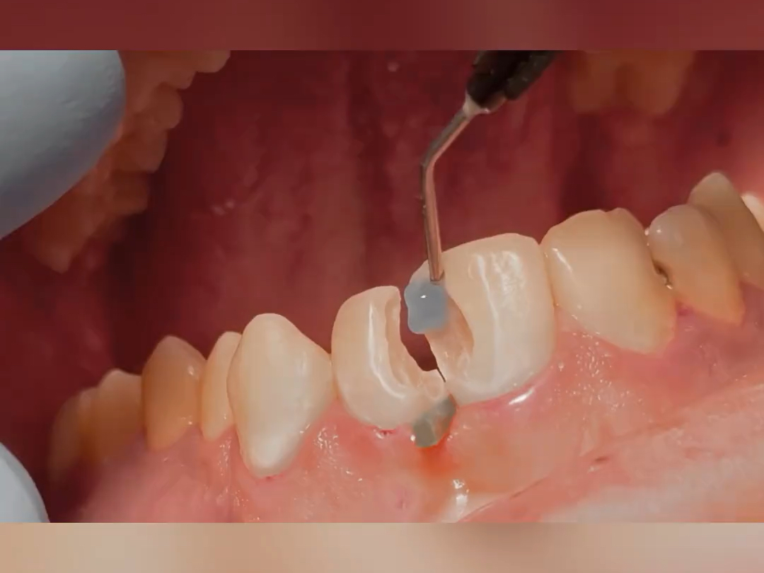 看起来不多的龋坏实际已经穿髓了,根管治疗后补牙过程!