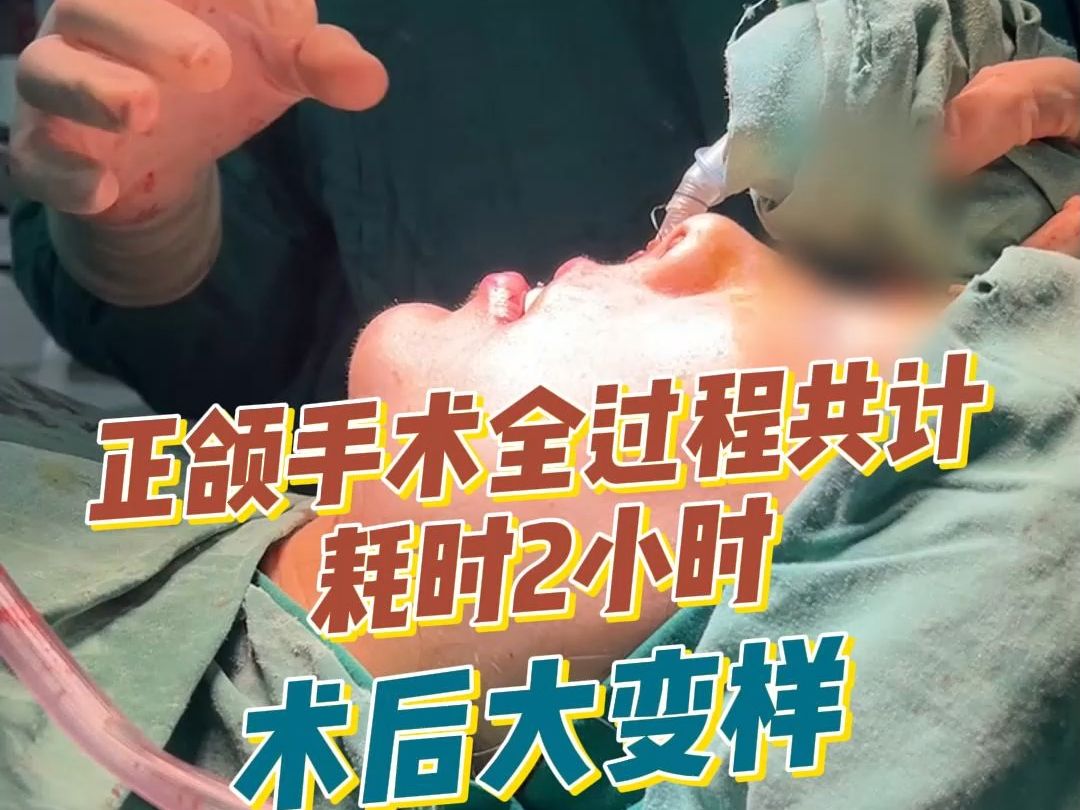 正颌手术全过程共计耗时2小时术后大变样