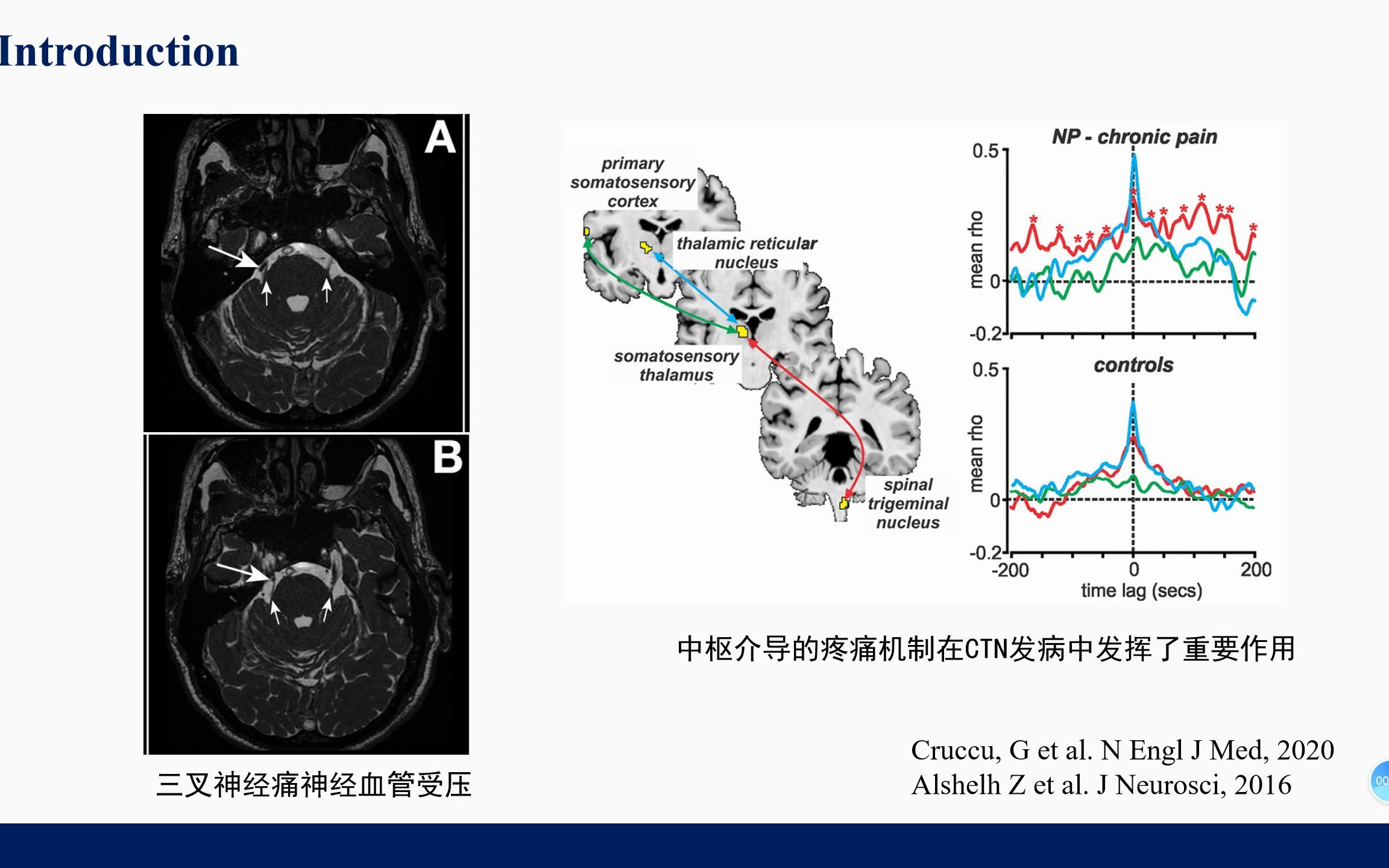 基于静息态功能磁共振成像的三叉神经痛脑功能网络动力学改变研究哔哩哔哩bilibili