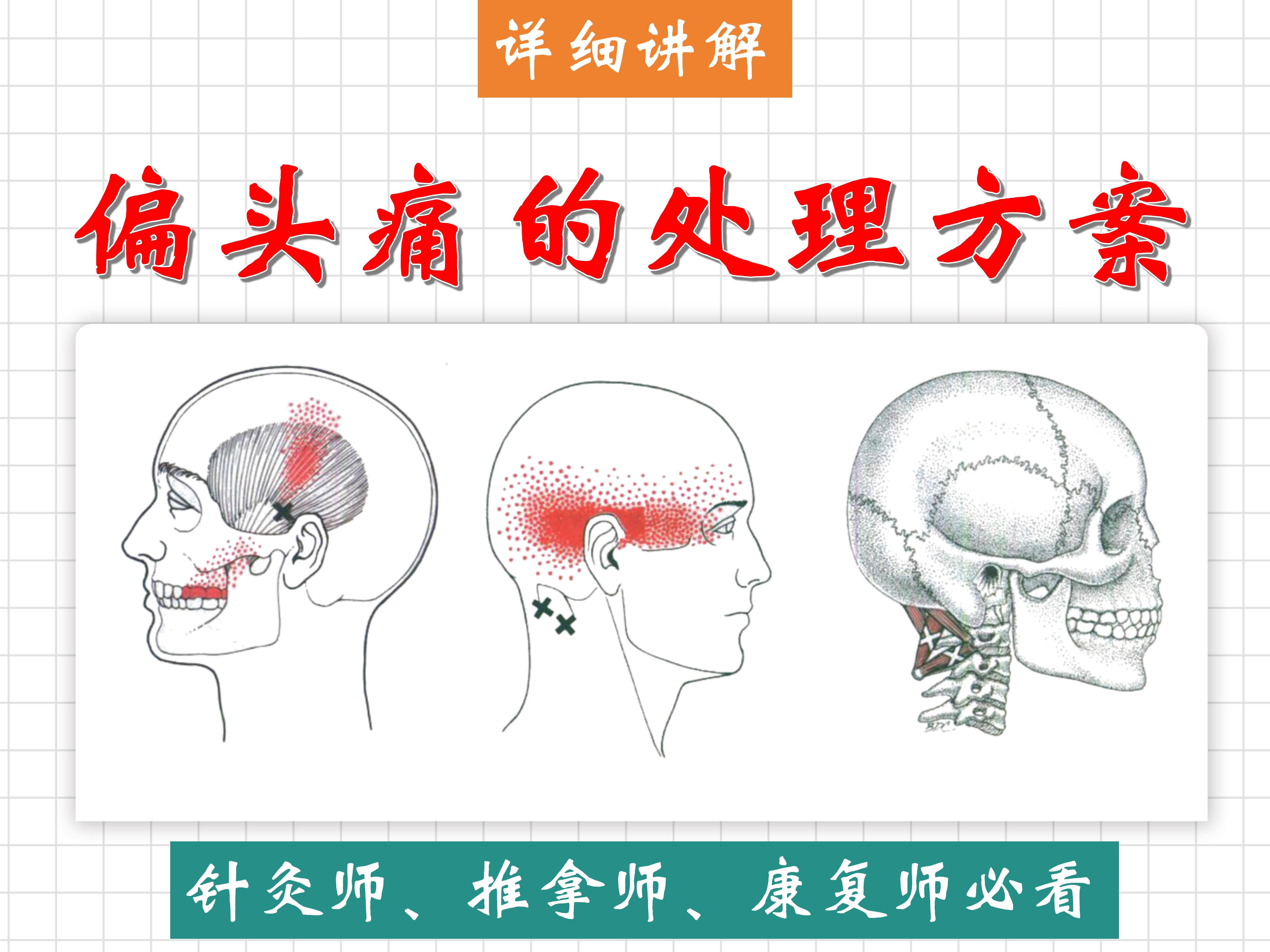 【偏头痛】怎么处理?——颞肌、胸锁乳突肌、枕下肌群、上斜方肌、颈椎单元化扎法——天下明医平台简灵奇针哔哩哔哩bilibili