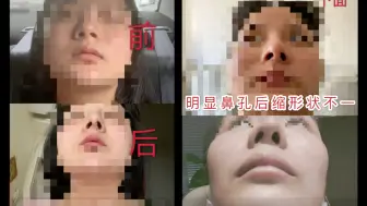 Descargar video: 多名女子整容后鼻子歪斜呼吸不畅 院方：是否担责需进行医疗鉴定