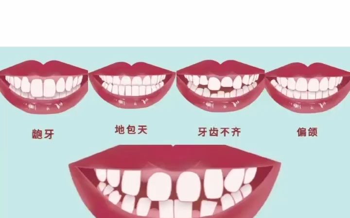 牙齿畸形的危害的有哪些?哔哩哔哩bilibili