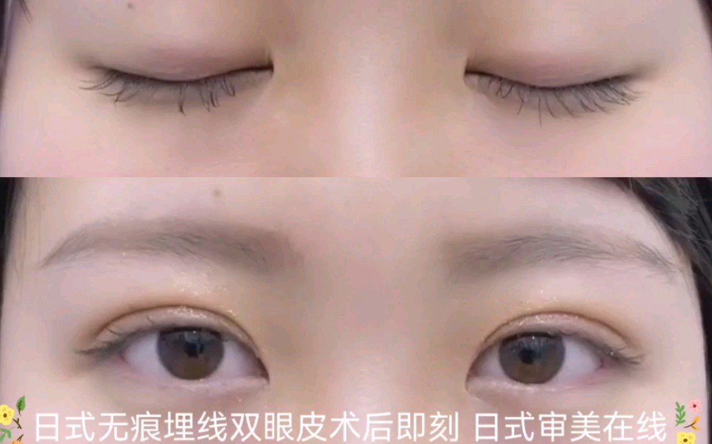 日式无痕埋线双眼皮即刻反馈