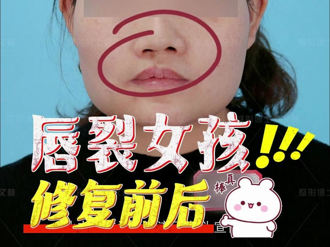 唇裂女孩修复前后