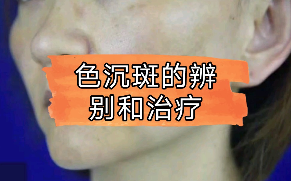 色沉斑的辨别及诊治哔哩哔哩bilibili