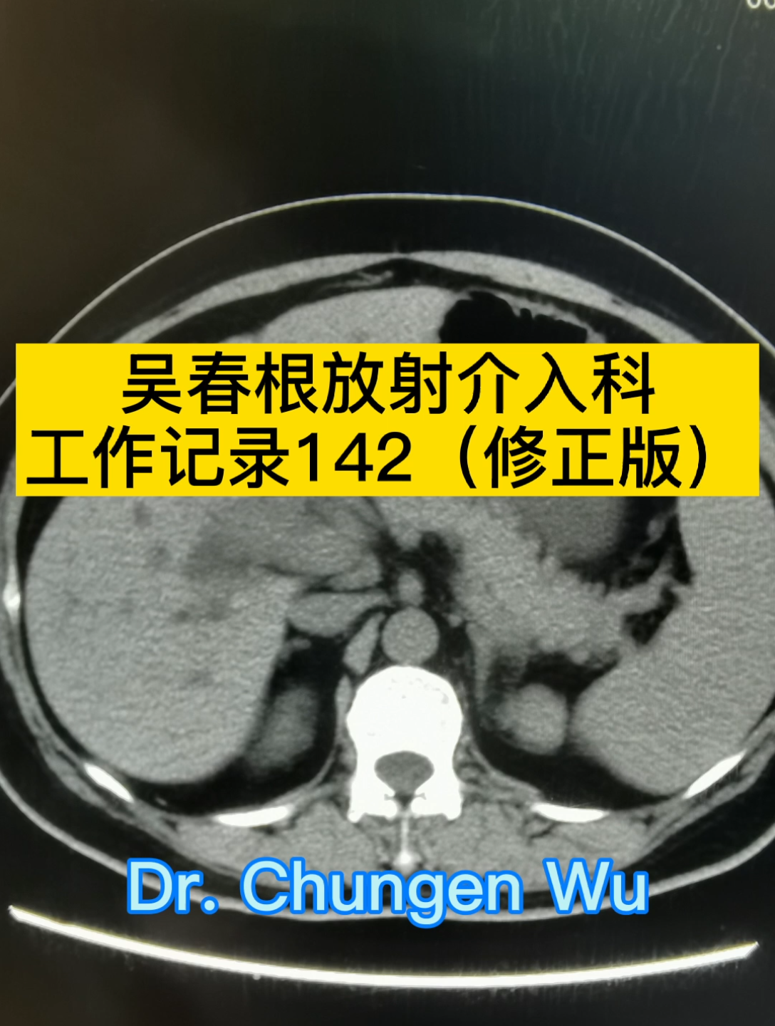 老年脊柱椎體壓縮性骨折骨轉移介入案例吳春根工作記錄142修正版