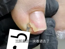 藏在里面一大块指甲！