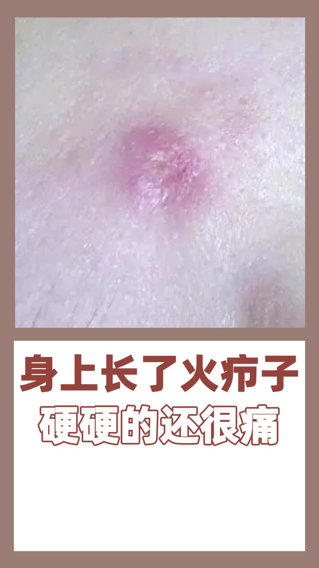 身上长了火疖子,硬硬的还很痛哔哩哔哩bilibili