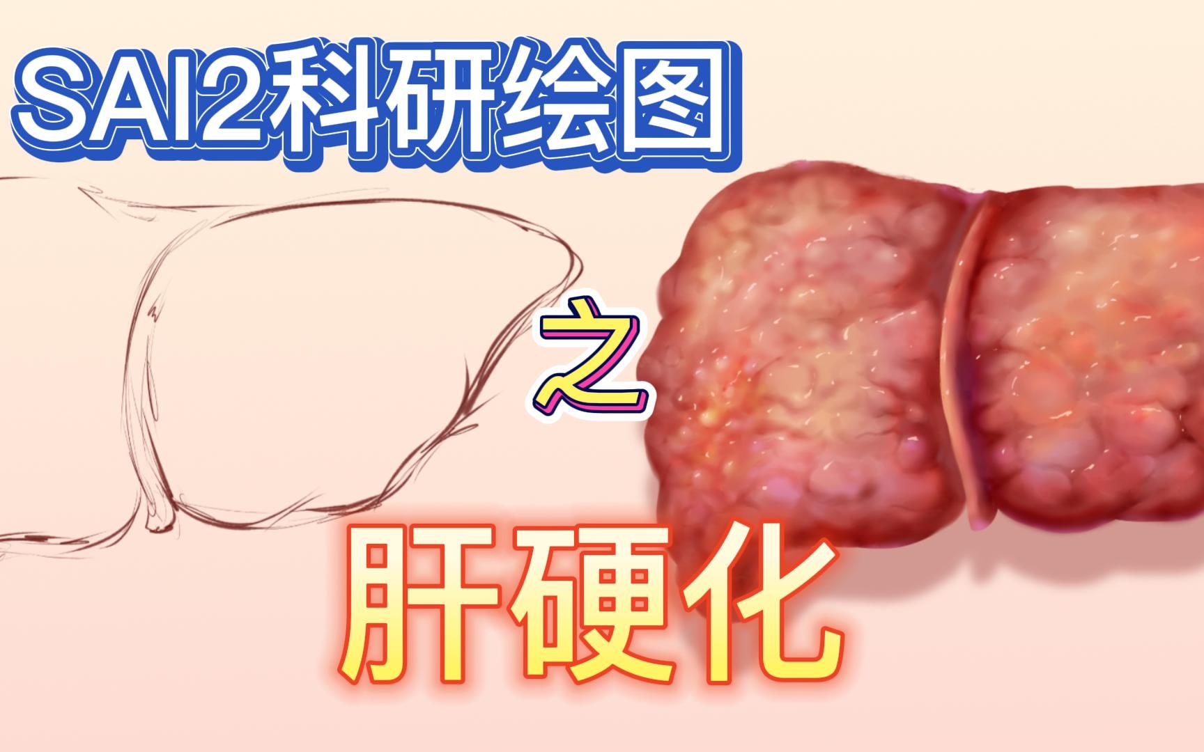 临床医学手绘 | 肝硬化篇哔哩哔哩bilibili