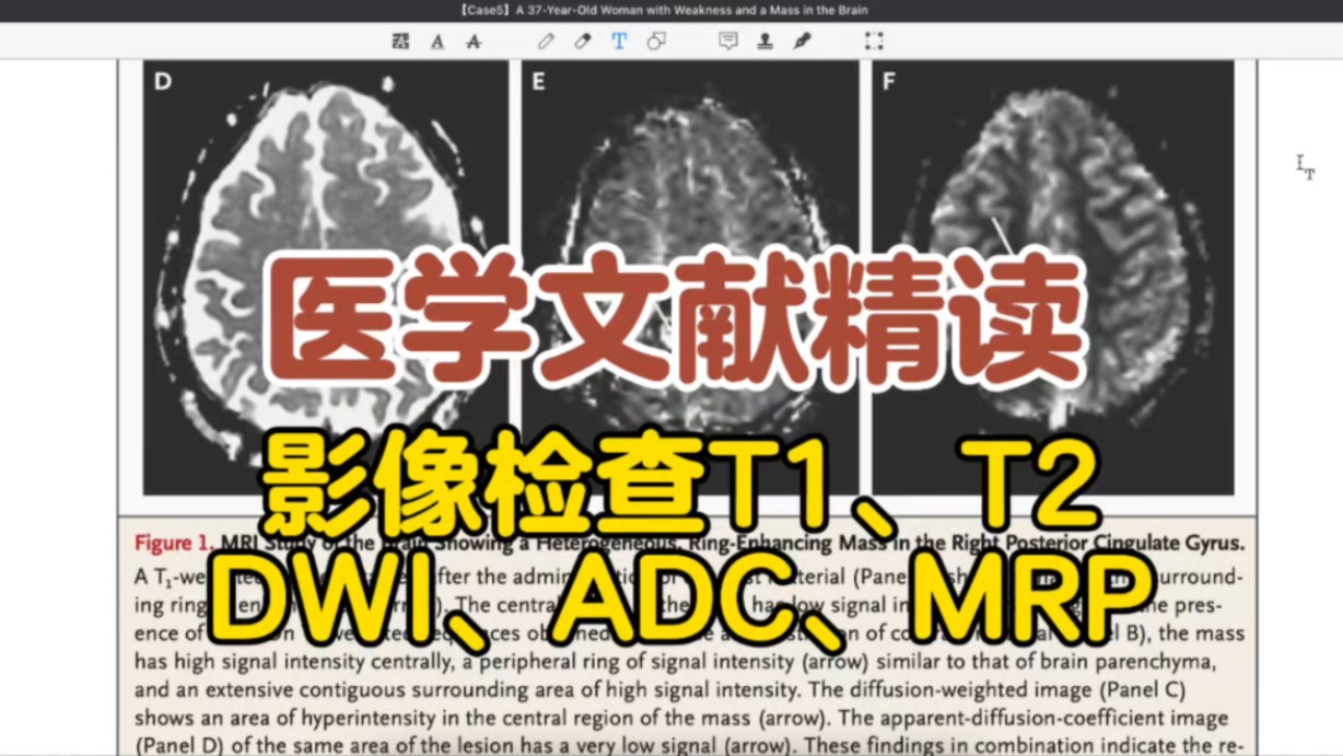 医学文献精读|医学英语|影像检查T1、T2、DWI、ADC、MRP哔哩哔哩bilibili