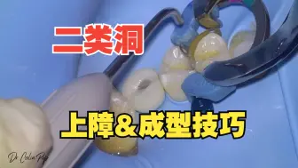 下载视频: 二类洞上障&上豆瓣成型的技巧