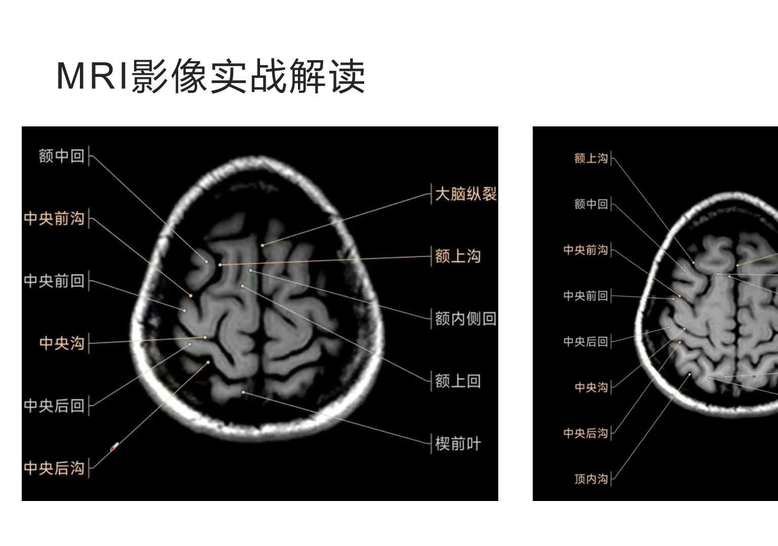 颅脑阅片磁共振(MRI)影像实战解读哔哩哔哩bilibili