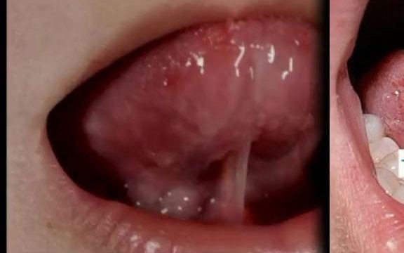 舌系带过长怎么办