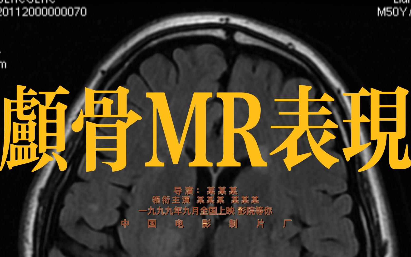 【MRI&Coka】脑磁基础知识@1.1@颅骨及其病变@磁共振@221219哔哩哔哩bilibili