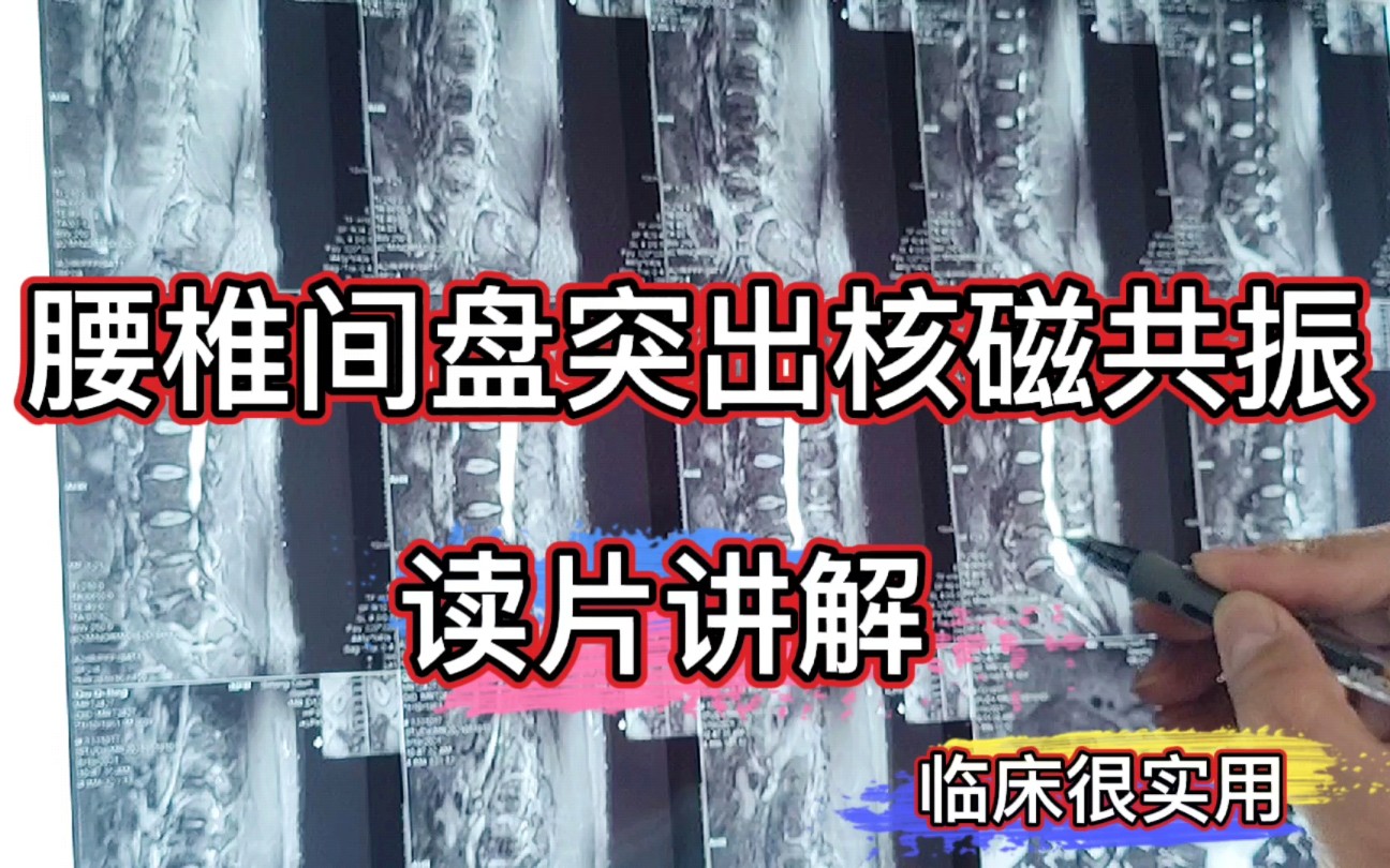 腰椎间盘突出怎么诊断? 腰椎核磁共振读片讲解,临床很实用哔哩哔哩bilibili