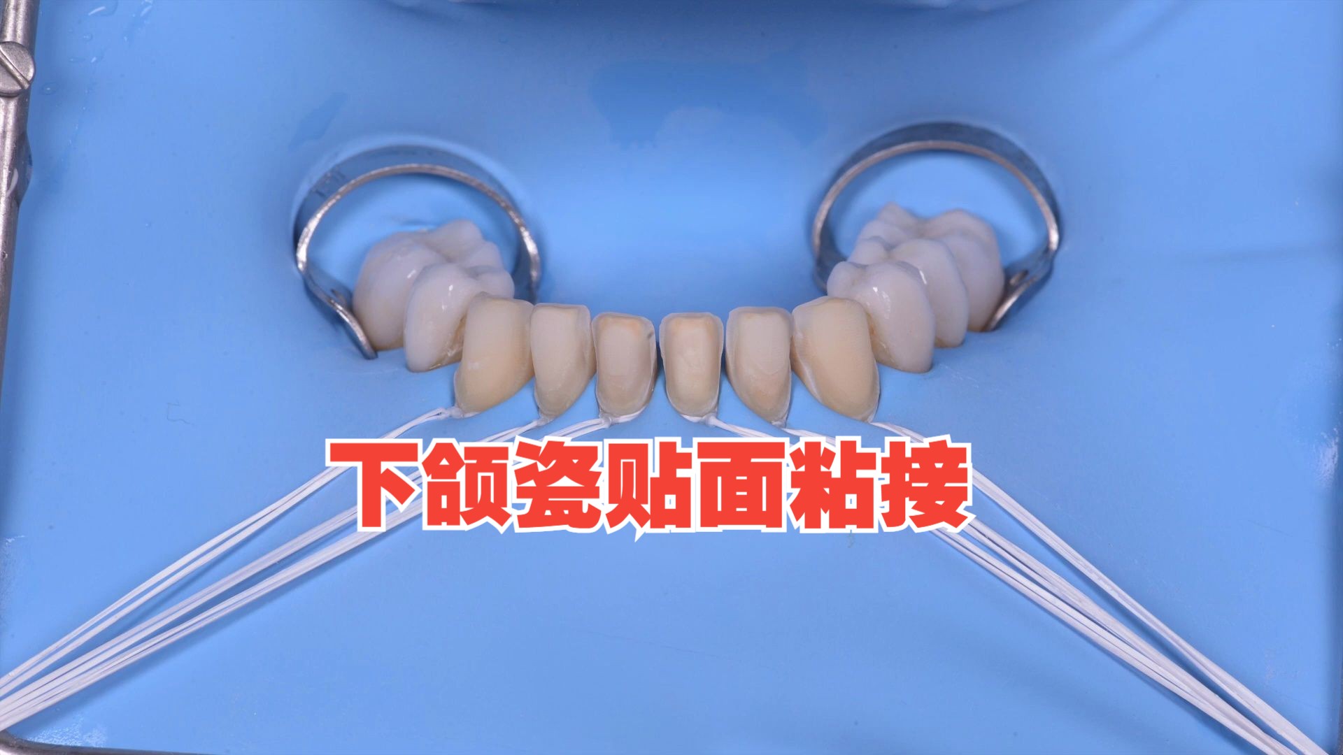 下颌瓷贴面粘接 Ceramic Veneer adhesive cementation  the no finishing concept.哔哩哔哩bilibili