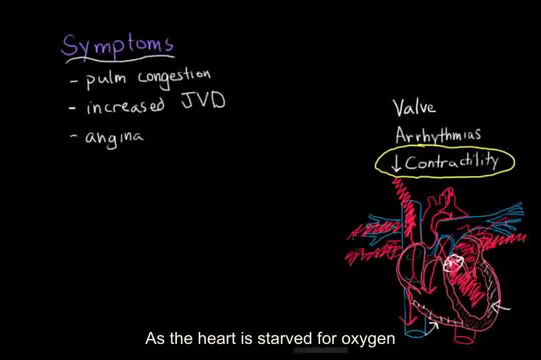 【搬运khanacademy】循环系统疾病——cardiogenicshock
