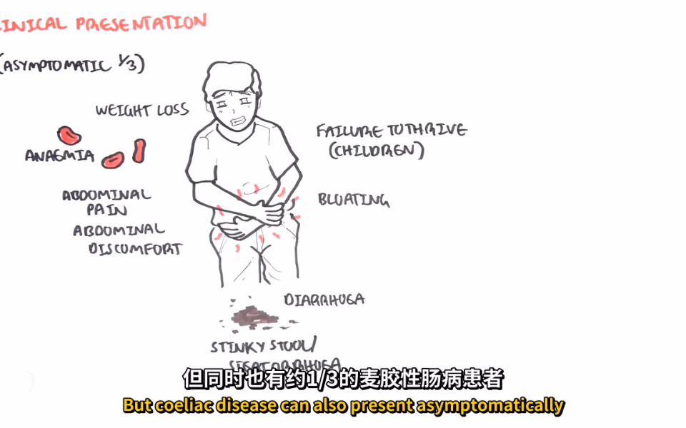 【双语】科教丨麦胶性肠病简介@阿尔法小分队科教组哔哩哔哩bilibili