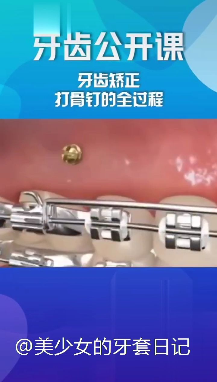 牙齿矫正骨钉的作用