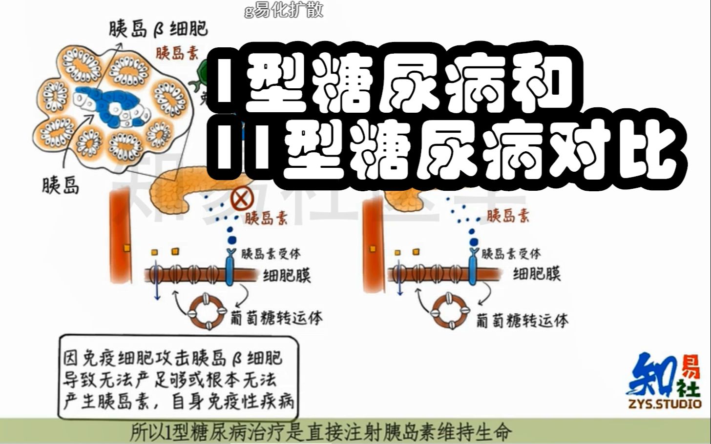 [图]科学掌握 1型糖尿病和2型糖尿病的区别