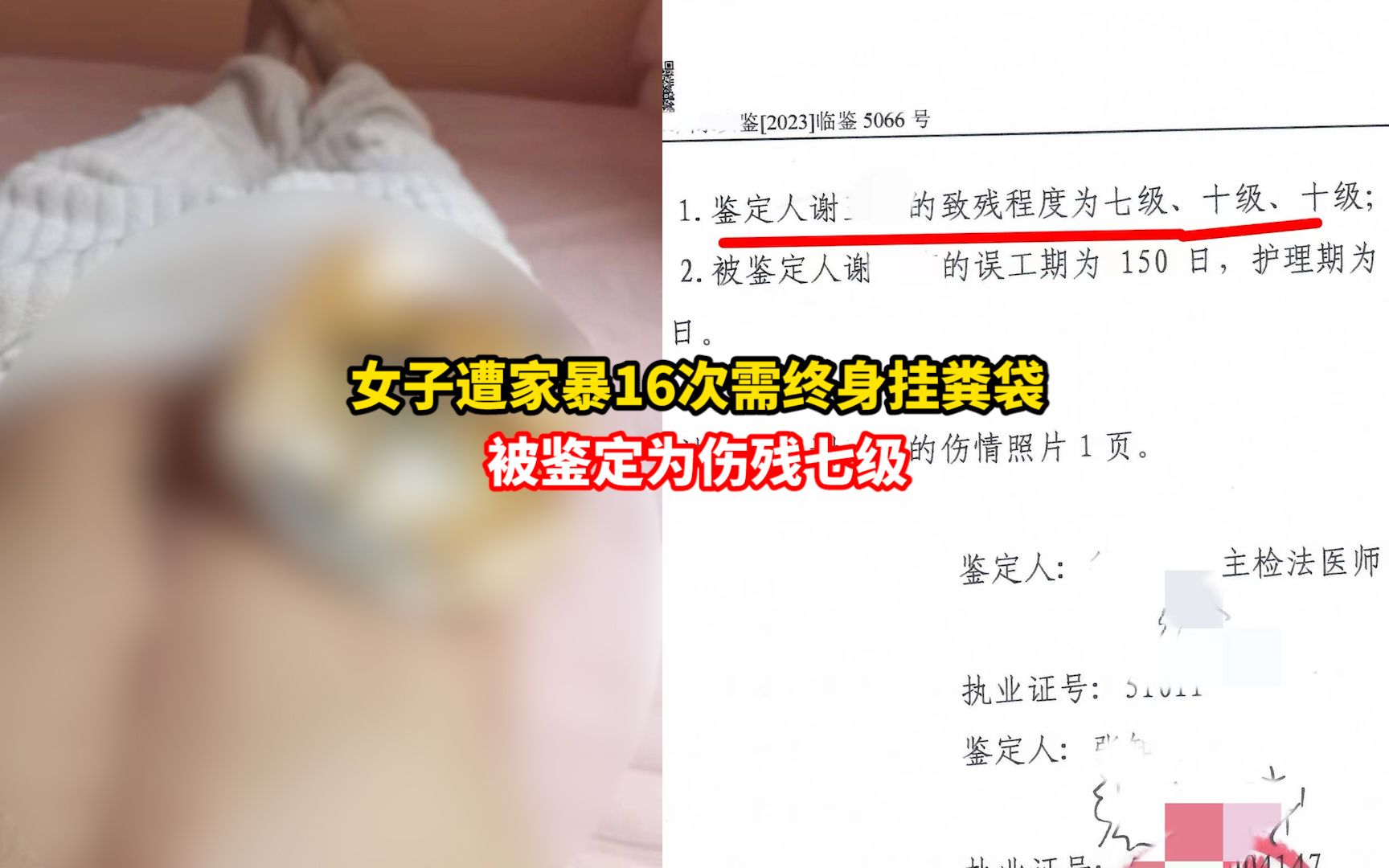 遭家暴16次女子鉴定为伤残七级,需终身戴着粪袋生活,目前仍未离婚成功哔哩哔哩bilibili