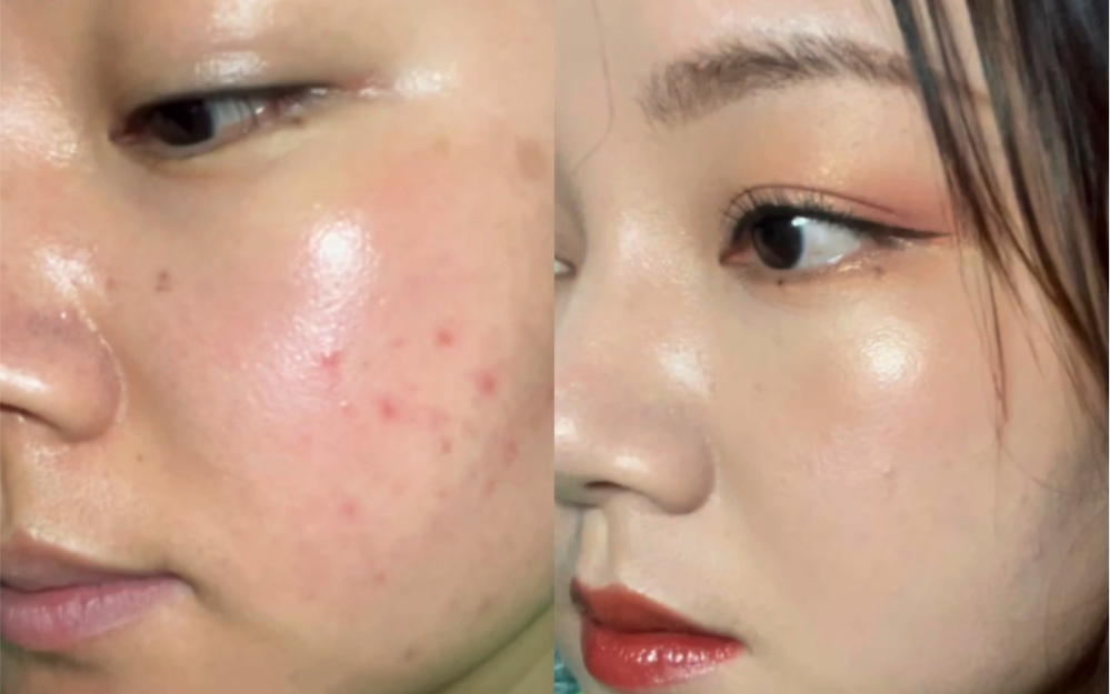 痘痘肌女孩怎么遮盖不厚重