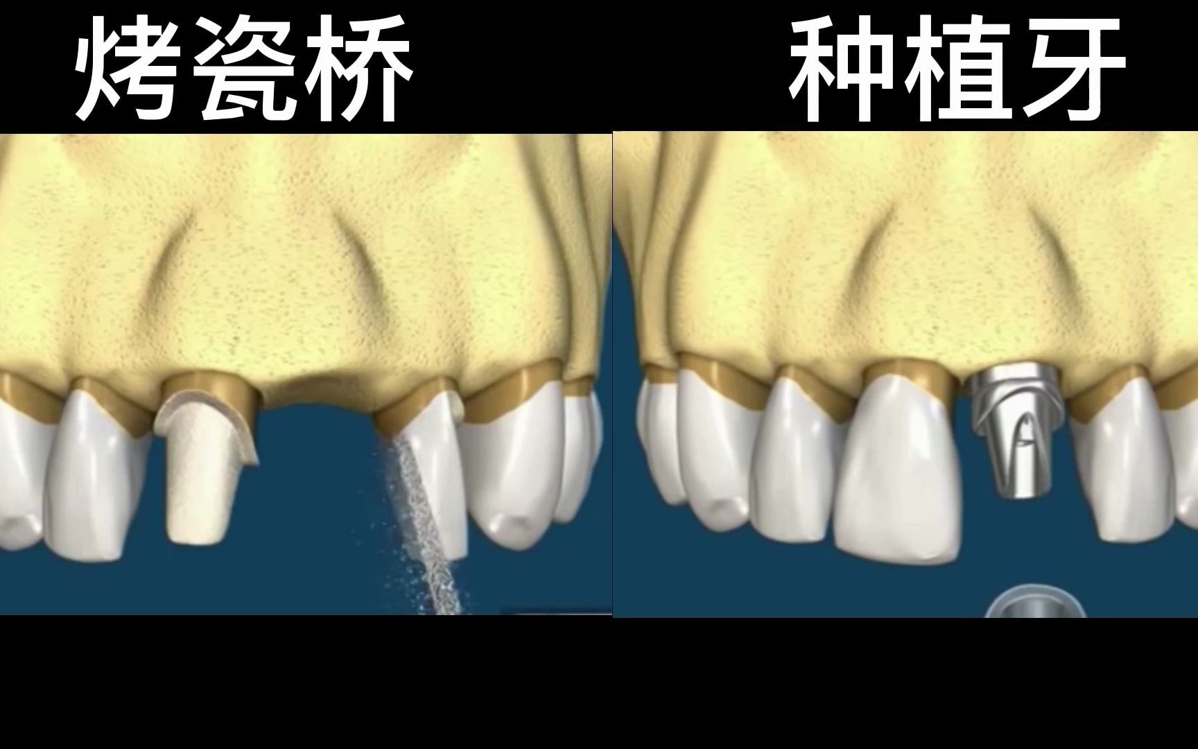一分钟带你全面了解种植牙与烤瓷牙的好与坏,看完就知道如何选择哔哩哔哩bilibili