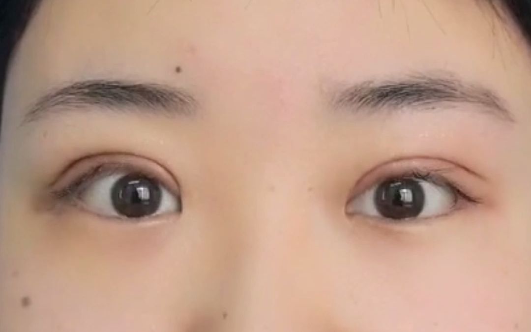 双眼皮术后7天终于摆脱内双肿眼泡大小眼啦