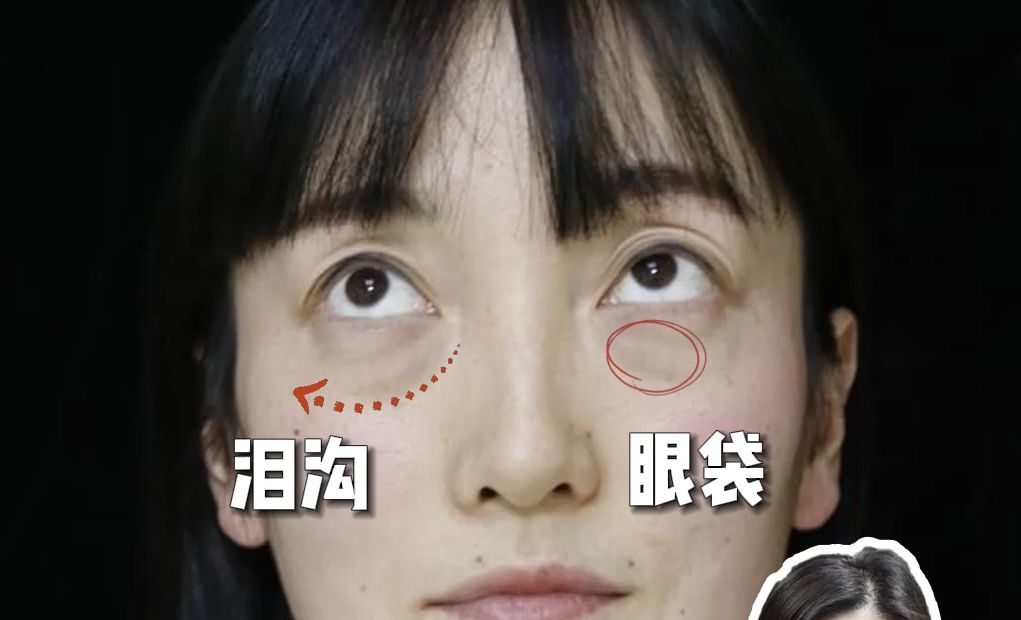 眼袋 泪沟,不开刀去眼袋搞定