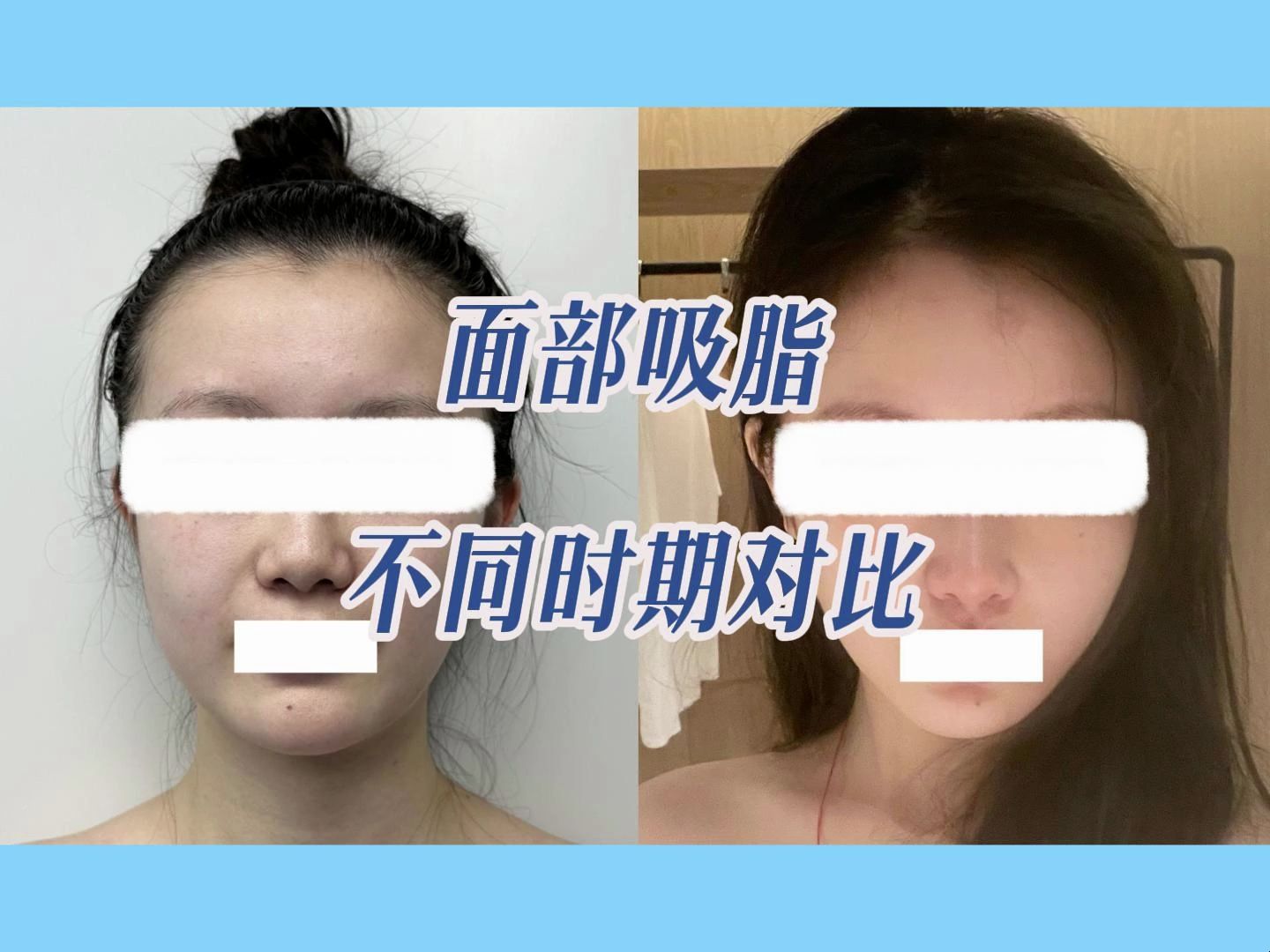 【案例】面部吸脂不同时期对比