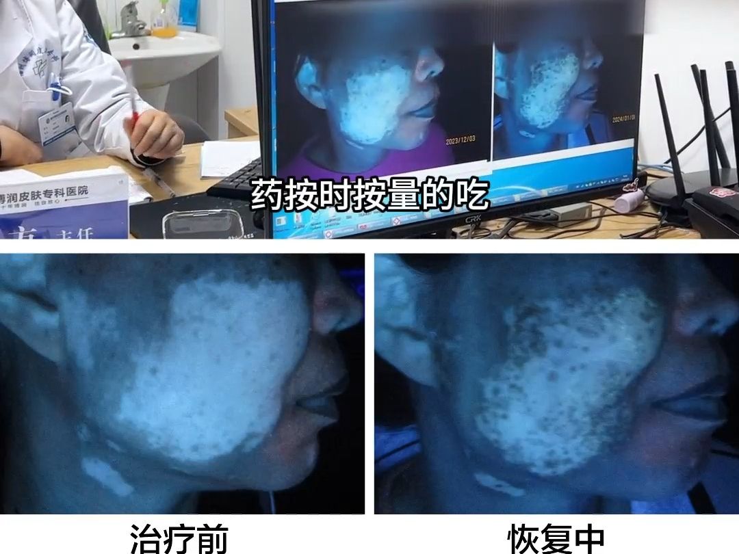 【厦门专科白癜风医院】医生讲要想白斑好得快 治疗频次和按时按量