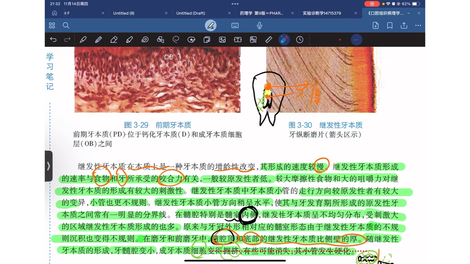 继发性牙本质图片