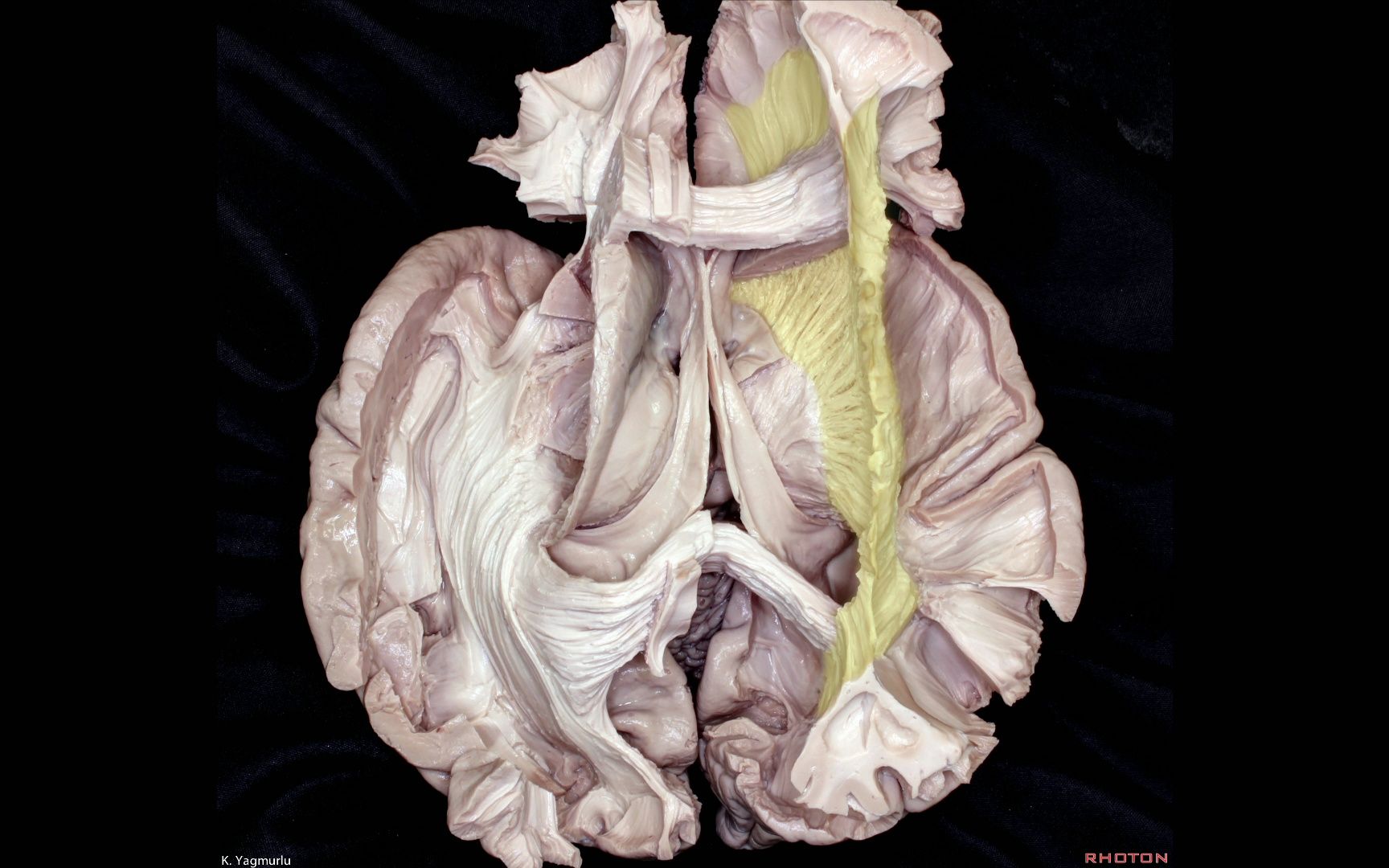 Fiber Pathways of the Cerebrum哔哩哔哩bilibili