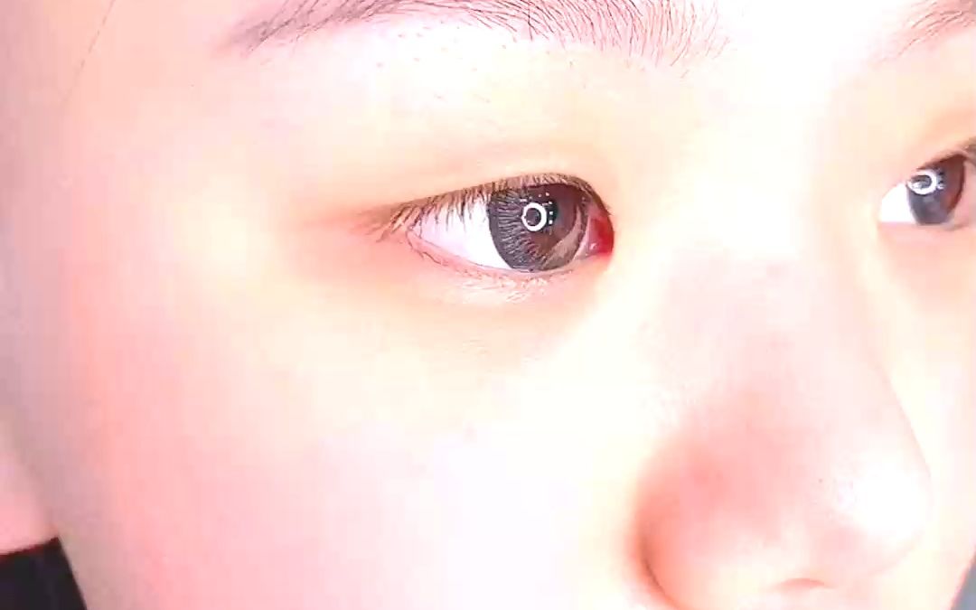 眼睛有点更圆了.#内眼角 #单眼皮调整 @抖音小助手