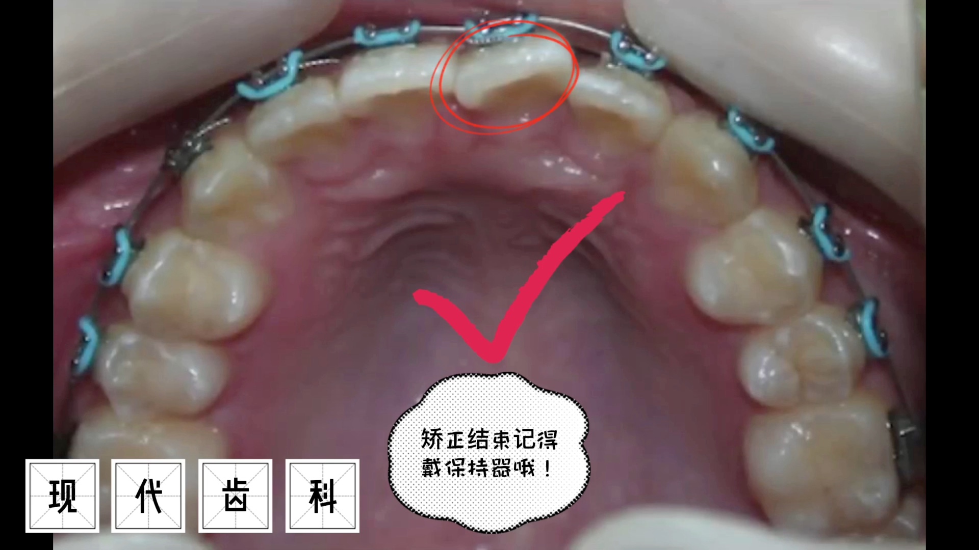 牙齿扭转畸形,这样矫正.哔哩哔哩bilibili