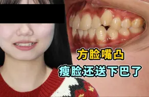 Video herunterladen: 【嘴凸下巴后缩女生】低角方脸不仅逆旋出下巴还瘦脸了！