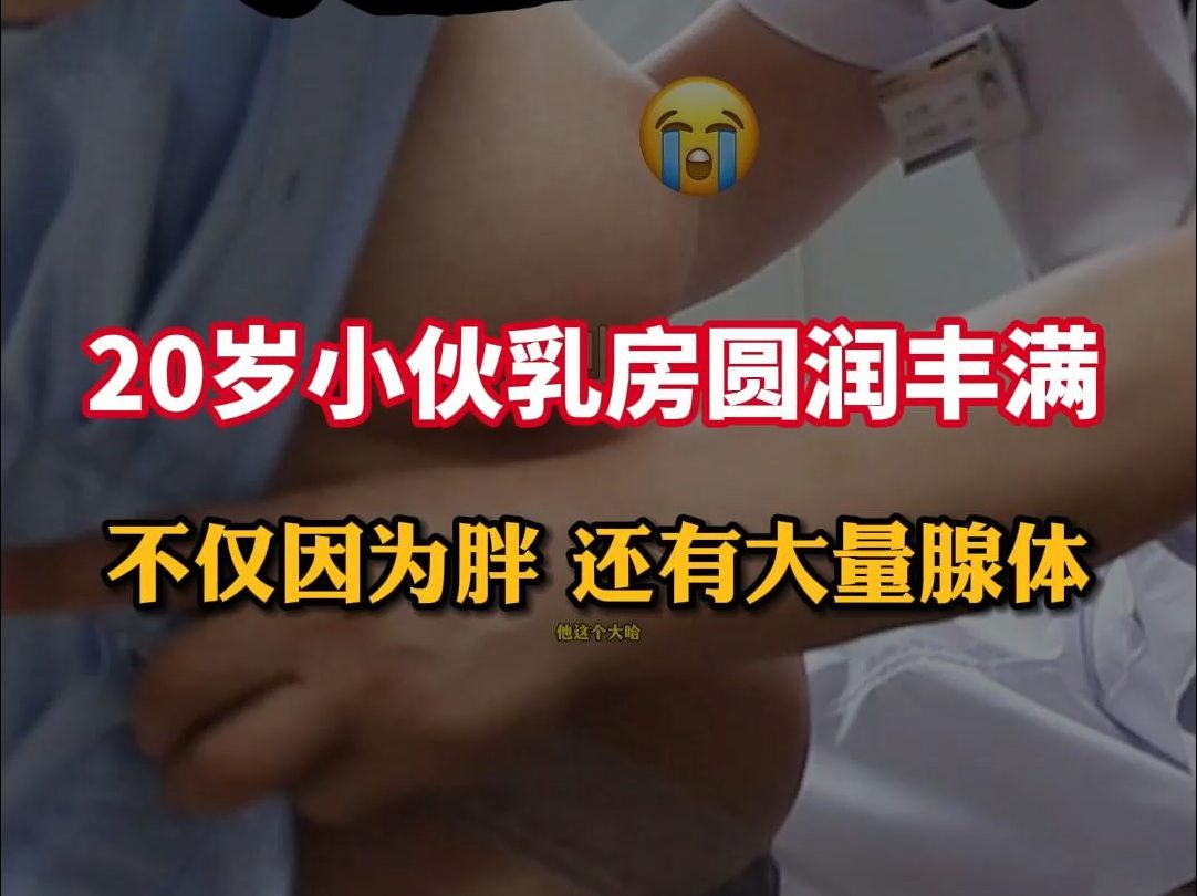 20岁小伙胸部圆润丰满,不仅肥胖脂肪堆积,乳腺也明显发育哔哩哔哩bilibili