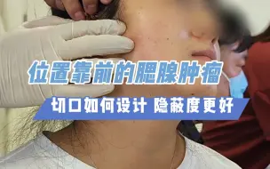 下载视频: 位置靠前的腮腺肿瘤，切口如何设计隐蔽度更好