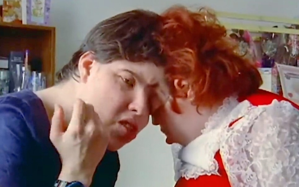 头部连体双胞胎,下半身瘫痪坐轮椅!永远看不到对方的脸