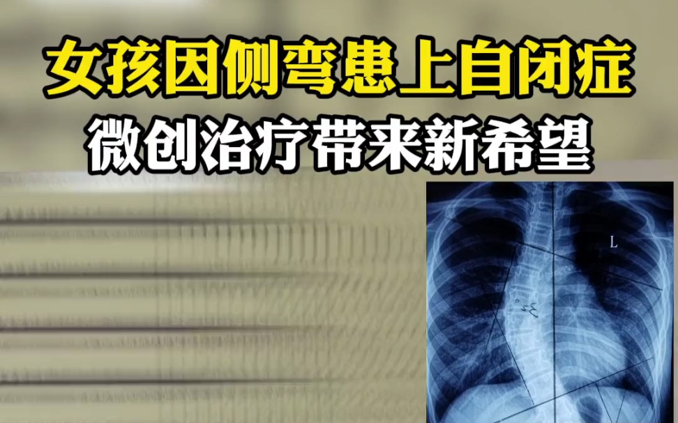 青春女孩脊柱侧弯35度,胸椎向右侧弯,剃刀背明显,矫正后变得乐观自信