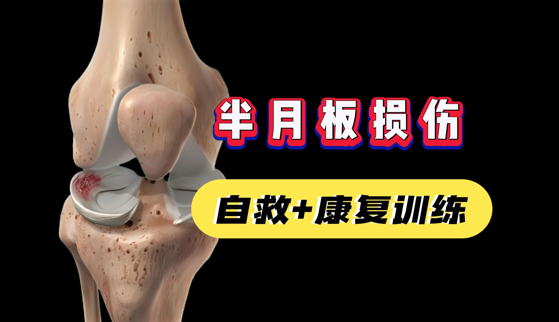 半月板损伤如何恢复?试试这几个动作