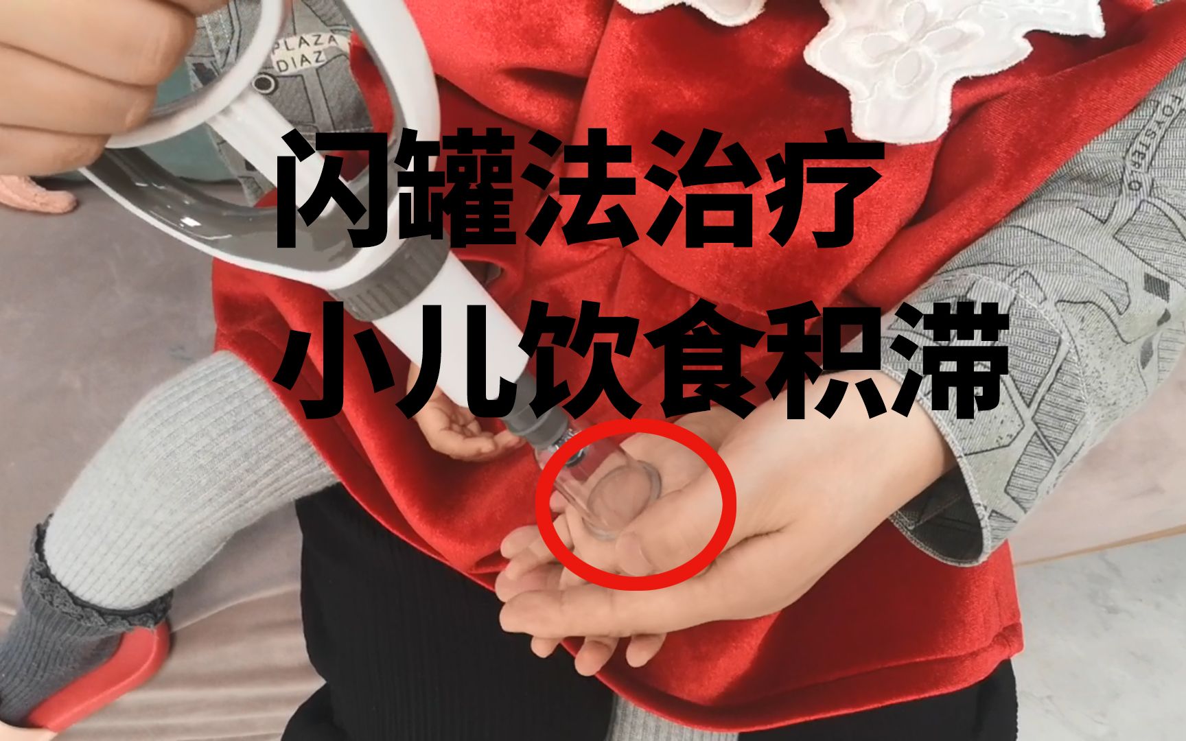 闪罐法不打针不吃药让小朋友在玩的过程中治好饮食积滞