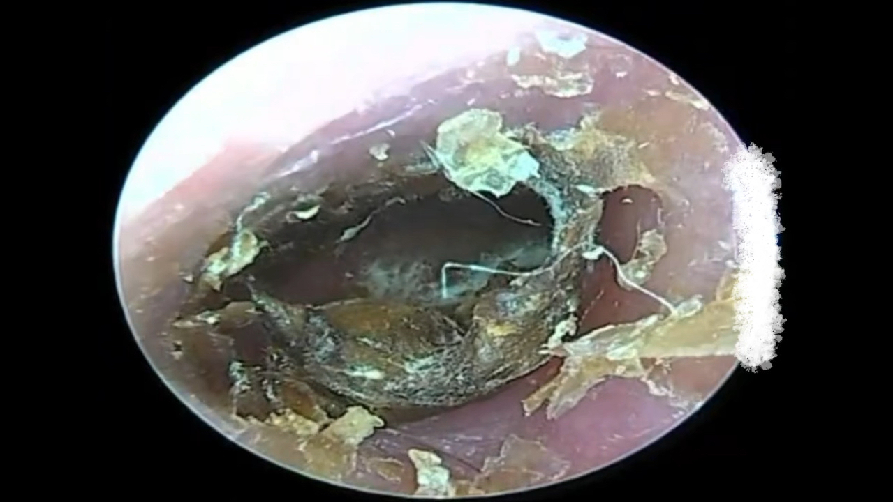 耳道霉菌干片;把这一大块发霉的耳屎!整块拔出来